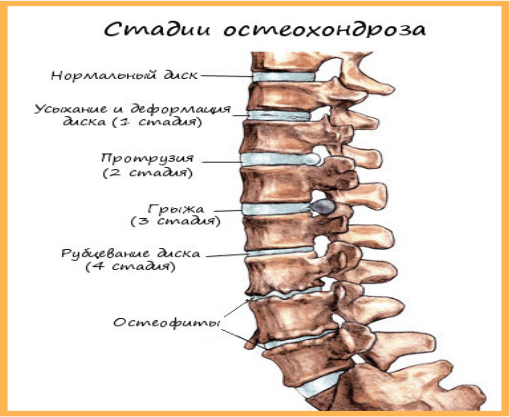 Санатории Пятигорска - лечение позвоночника, спины и грыжи